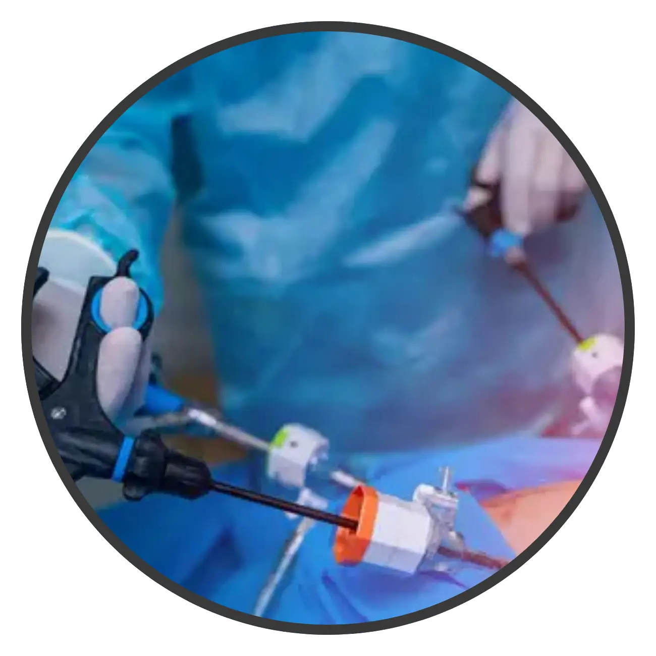 Hernia Inguinal Laparoscópica