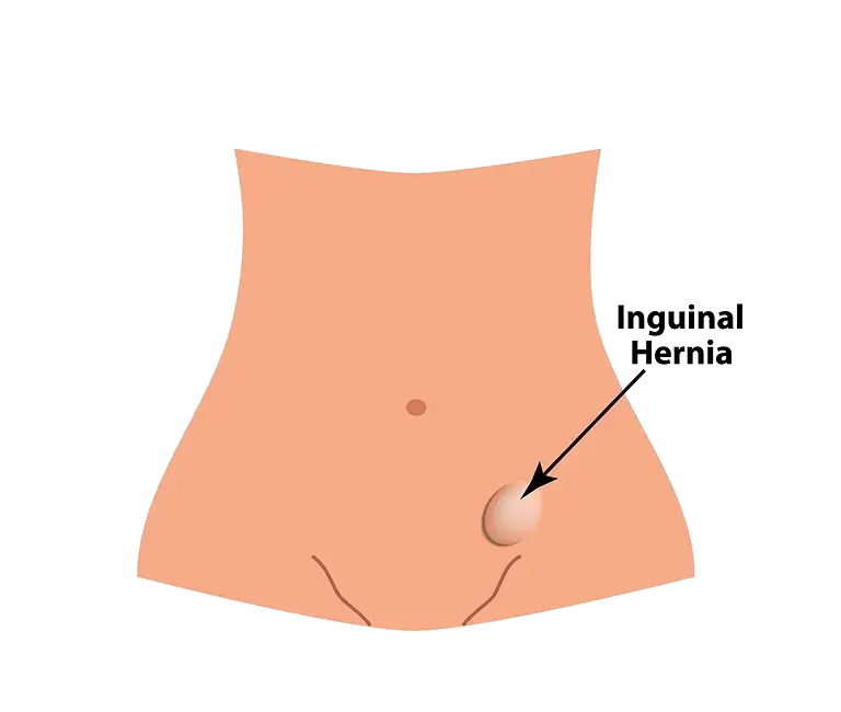 Hernia Inguinal